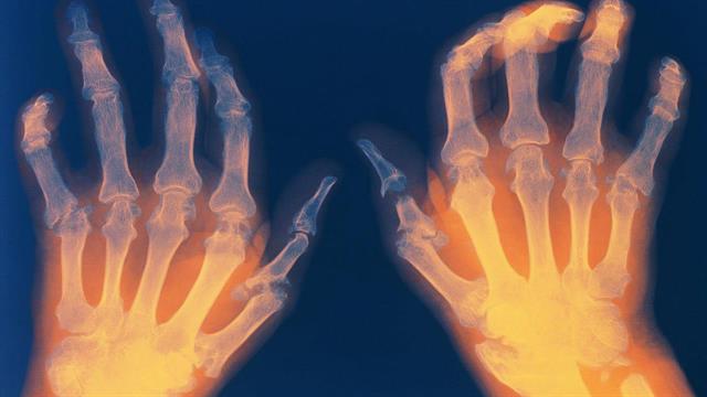 Ρευματοειδής αρθρίτιδα: Όταν η έξαρση ανατρέπει τα πάντα
