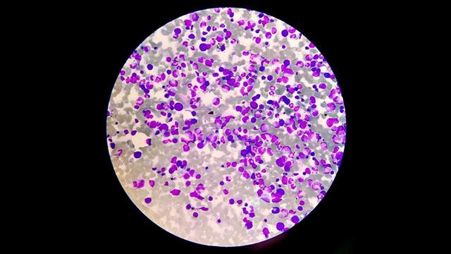 Ο Μάρτιος, μήνας ευαισθητοποίησης για το πολλαπλούν μυέλωμα