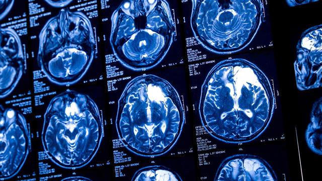 ‘Ερευνα συνδέει την καρδιοπάθεια με συρρίκνωση του εγκεφάλου