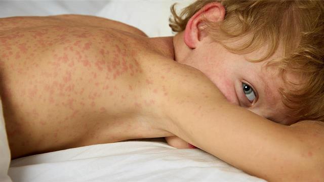 ECDC: Τι συμβαίνει με την ιλαρά στην Ευρώπη - Τα κρούσματα στην Ελλάδα