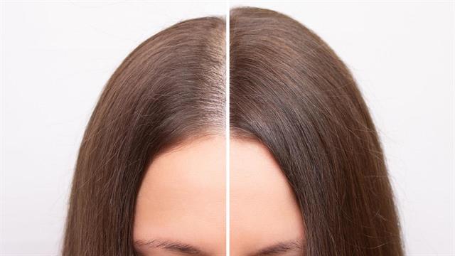 Τριχόπτωση: Πότε δεν είναι φυσιολογική