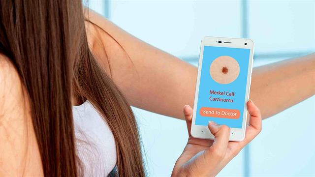 Αντιπαρασιτικό φάρμακο πιθανόν αναστρέφει την καρκινική ανάπτυξη στο καρκίνωμα των κυττάρων Merkel [μελέτη]