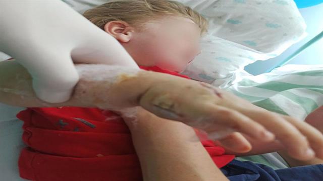 Δάγκωμα οχιάς: Γιατί είναι απαραίτητη η εμπλοκή και του ορθοπαιδικού