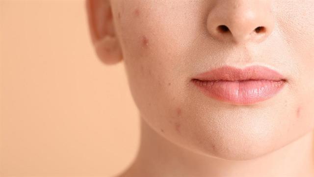 Ακμή ενηλίκων: Συνδέεται με αυξημένο κίνδυνο εμφάνισης διατροφικών διαταραχών [μελέτη]