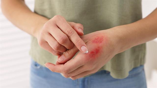 Η Τεχνητή Νοημοσύνη στην αντιμετώπιση των εγκαυμάτων