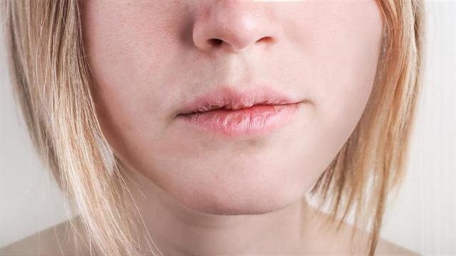 Ξηροστομία: Πώς μπορώ να την αντιμετωπίσω