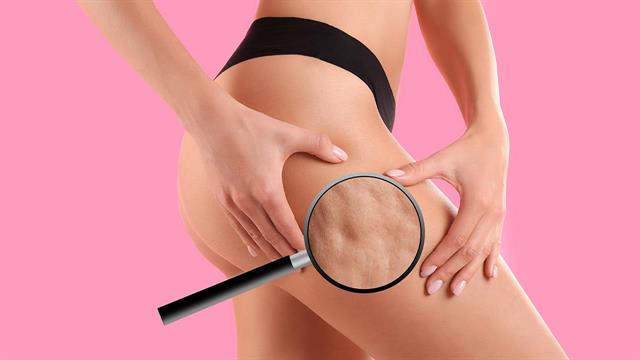 Μπορώ να μειώσω την κυτταρίτιδα;