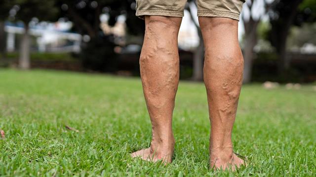 Κιρσοί και φλεβική ανεπάρκεια