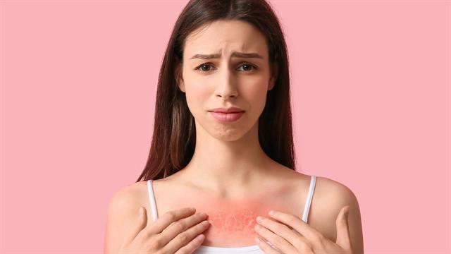 Πώς μπορώ να ανακουφιστώ από ένα ηλιακό έγκαυμα