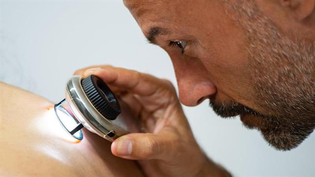 Αιμ. Λάλλας: Σωτήρια η ανοσοθεραπεία για 1 στους 2 ασθενείς με μεταστατικό μελάνωμα