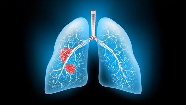 Γενική πρώιμη διάγνωση καρκίνου του πνεύμονα στη Γερμανία