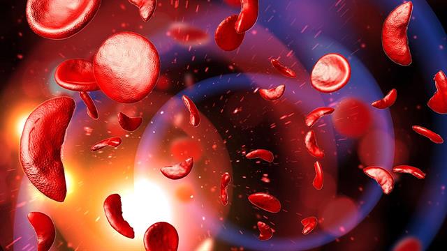 Βήτα-θαλασσαιμία και σοβαρή δρεπανοκυτταρική αναιμία: Πόσο χρήσιμη είναι η γονιδιακή επεξεργασία