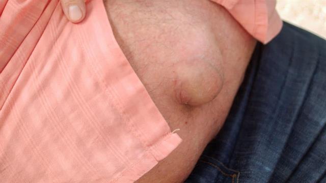 Οι 3 πιο συχνές κήλες του κοιλιακού τοιχώματος: Διάγνωση και αντιμετώπιση