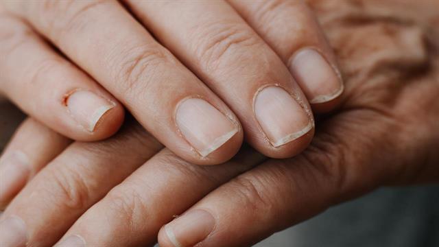 Νύχια: Τι μπορούν να δείξουν για την υγεία μας
