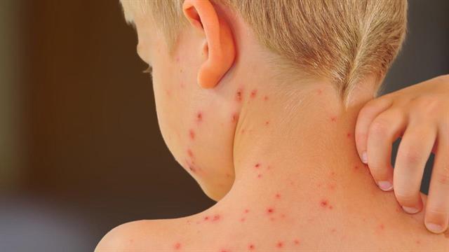 Ιλαρά: Η περσινή αύξηση των κρουσμάτων είναι η μεγαλύτερη των τελευταίων 30 χρόνων