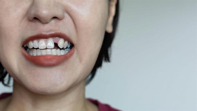 Η χρόνια νεφρική νόσος ενδεχομένως συνδέεται με υψηλότερο κίνδυνο απώλειας δοντιών