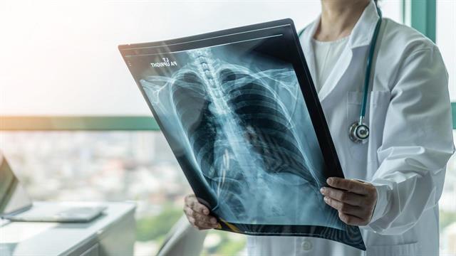 Ινωση πνευμόνων και αυξημένος κίνδυνος καρκίνου του πνεύμονα [μελέτη]