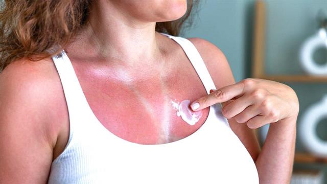 Ποια σπιτικά φάρμακα επουλώνουν τα ηλιακά εγκαύματα