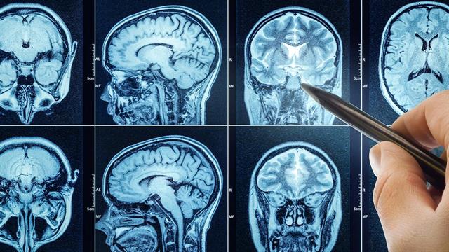 Ογκος στον εγκέφαλο: Θεραπεία με πάγωμα των κυττάρων