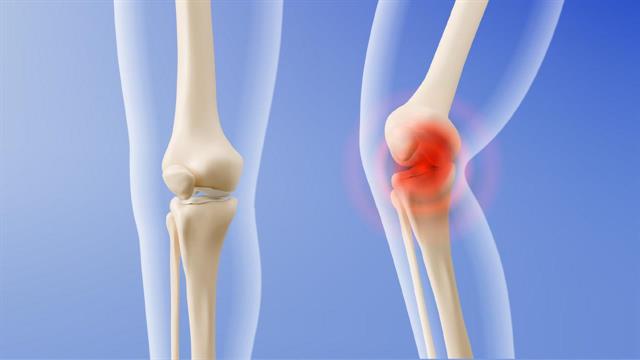 Τι σημαίνει για τα οστά η διακοπή της ορμονικής θεραπείας