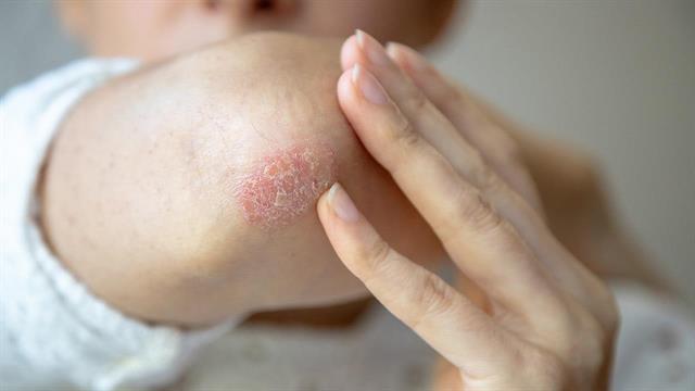 Tα οφέλη των αναστολέων της ιντερλευκίνης-17 στην ψωρίαση