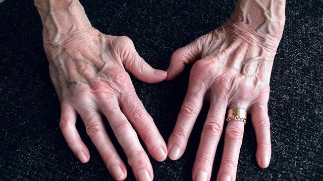 Φταίει το πρόωρα γερασμένο ανοσοποιητικό σύστημα για τη ρευματοειδή αρθρίτιδα;