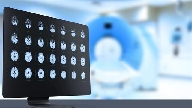 Όγκοι εγκεφάλου στα παιδιά: Πώς τα ανοσοκύτταρα του περιβάλλοντος του όγκου καθορίζουν την επιτυχία της θεραπείας