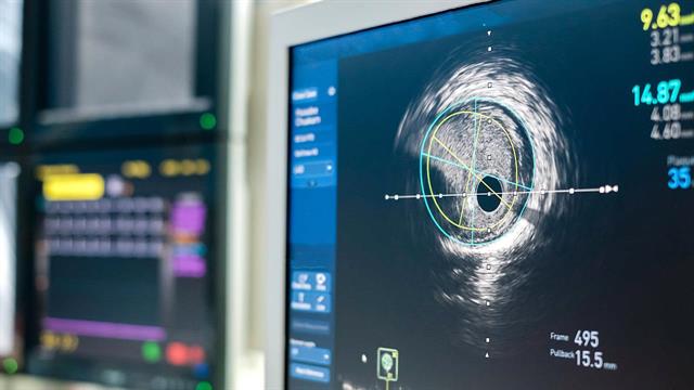 Το ασβέστιο προβλέπει τις αρρυθμίες μετά από καρδιοχειρουργική επέμβαση [μελέτη]