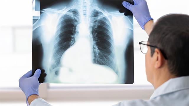 Η απλή εξέταση δεν αρκεί για την πρόβλεψη της φυματίωσης σε άτομα με εξασθενημένο ανοσοποιητικό