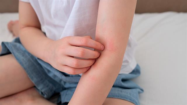 Ο FDA ενέκρινε κρέμα για την ατοπική δερματίτιδα στα παιδιά