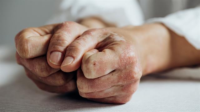 Ψωριασική αρθρίτιδα: Υποσχόμενο φάνηκε φάρμακο σε δοκιμή αρχικού σταδίου