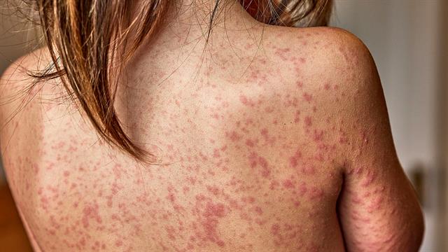 Ιλαρά: 7.000 κρούσματα στην Ευρώπη τον Σεπτέμβριο