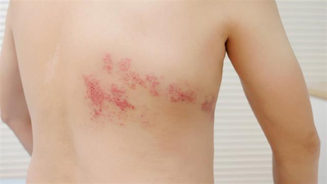 Το εμβόλιο για τον έρπητα ζωστήρα προστατεύει και από καρδιοπάθεια και άνοια