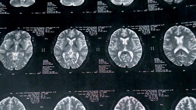 Πολλαπλή σκλήρυνση: Πώς βλάπτει τον εγκέφαλο χρόνια πριν την εμφάνιση συμπτωμάτων