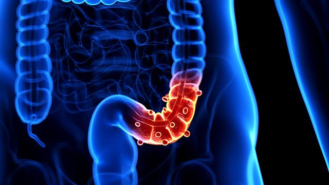 Εκκολπωμάτωση παχέος εντέρου: Παράγοντες κινδύνου και θεραπευτικές επιλογές