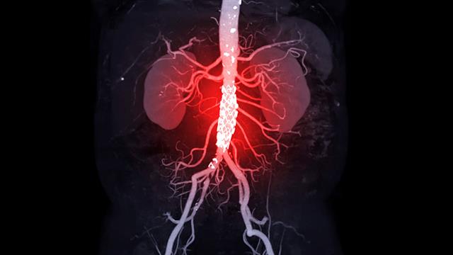 Γιατί χρειάζομαι επέμβαση καρδιάς ενώ δεν έχω κανένα σύμπτωμα