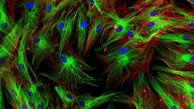 Καρδιακή ανεπάρκεια: Οι ινοβλάστες επιταχύνουν τη βλάβη [μελέτη]