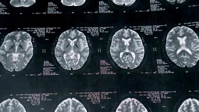 Η CNX Therapeutics αποκτά το Sativex από την Jazz Pharmaceuticals