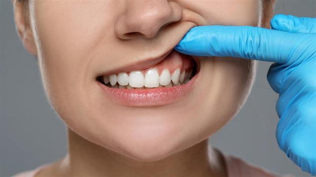 Περιοδοντίτιδα: Πώς σχετίζεται με  συστηματικά νοσήματα και άνοια