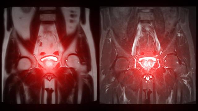 Σημαντικές εξελίξεις στην αντιμετώπιση του ουροθηλιακού καρκίνου