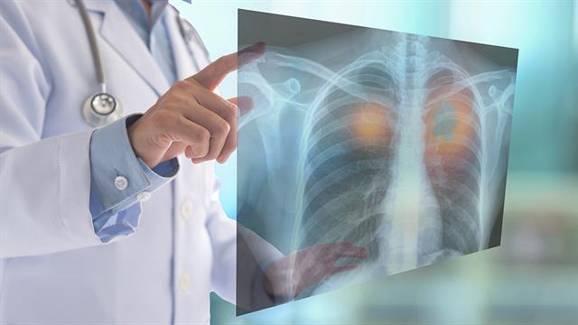 Παγκόσμια μείωση των νέων κρουσμάτων φυματίωσης