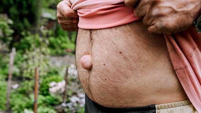 Ομφαλοκήλη: Αίτια, συμπτώματα, παράγοντες κινδύνου και θεραπεία