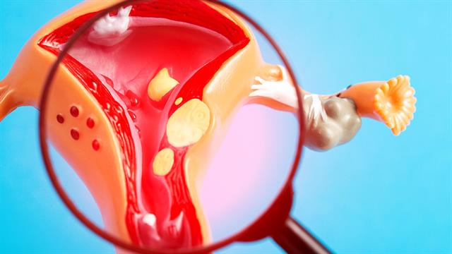 Ινομυώματα: Προάγγελος μελλοντικής καρδιαγγειακής νόσου;