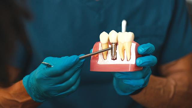 Οδοντίατροι: Προσοχή σε παραπλανητικές διαφημίσεις για γρήγορα εμφυτεύματα