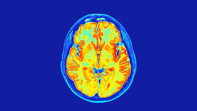 Η COVID-19 αφήνει σημάδι διαρκείας στον ανθρώπινο εγκέφαλο