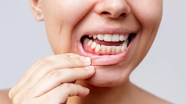 Η ουλίτιδα μπορεί να συνδέεται με αυξημένο κίνδυνο σοβαρών καρδιαγγειακών επεισοδίων