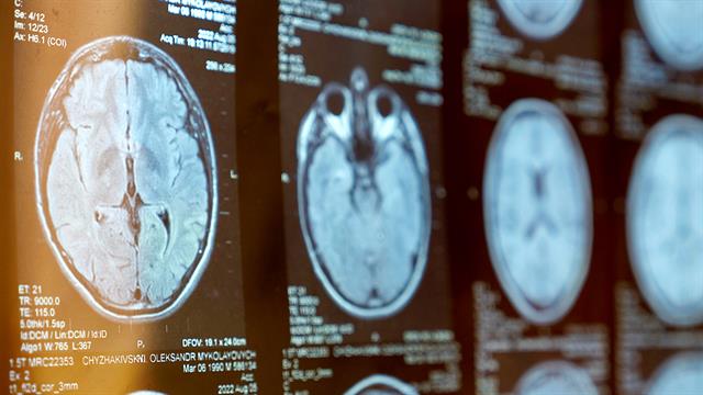 Αναθεώρηση των διαγνωστικών κριτηρίων της πολλαπλής σκλήρυνσης: Καινοτομία και κλινικός αντίκτυπος