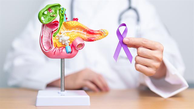 Νέο σκορ κινδύνου βοηθά στην πρόβλεψη της υποτροπής του καρκίνου στο πάγκρεας