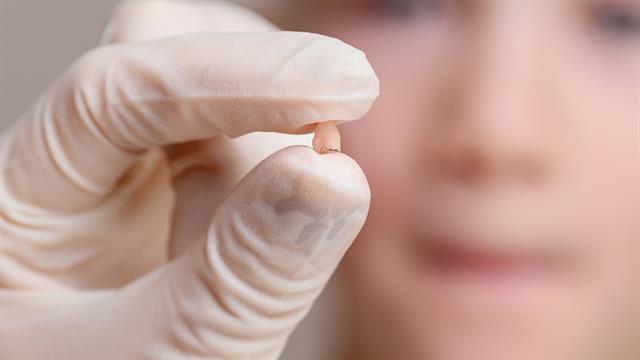 Σχετίζεται η απώλεια δοντιών με τη γνωστική εξασθένηση; [μελέτη]