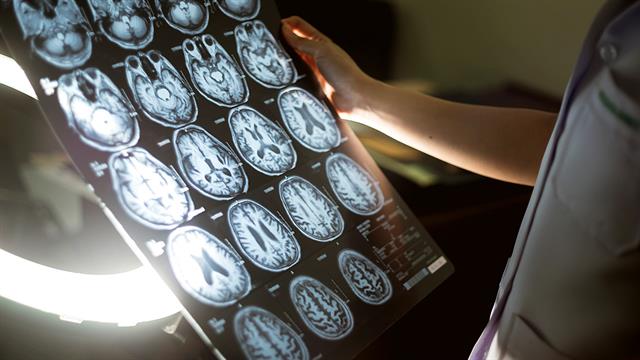 Μικραίνει ο εγκέφαλος όσο μεγαλώνουμε;